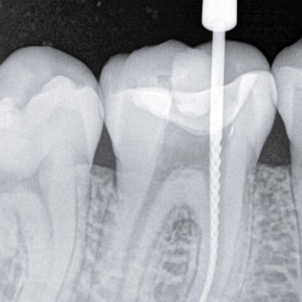 2-endodonzia2 2-endodonzia2